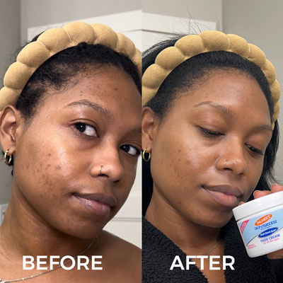 Black woman's before and after using Palmer's Skin Success with 5% niacinamide concentration